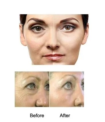dermaroller-540-tytanowych-igiel-do-twarzy-i-ciala-mezoterapia-zloty-zasilanie-brak