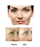dermaroller-540-tytanowych-igiel-do-twarzy-i-ciala-mezoterapia-zloty-zasilanie-brak