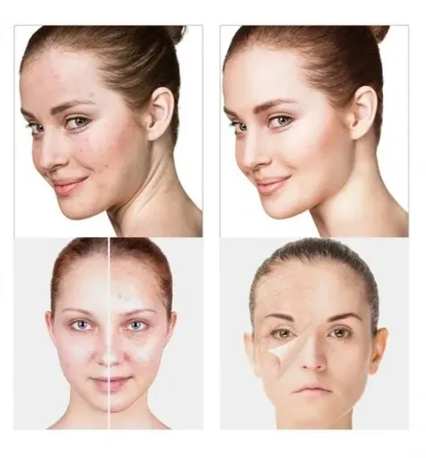 darsonval-derma-wand-darsonwal-mocny-4-peloty-stan-nowy