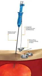 zestaw-wprowadzajacy-do-zglebnikow-gastrostomijnych-g