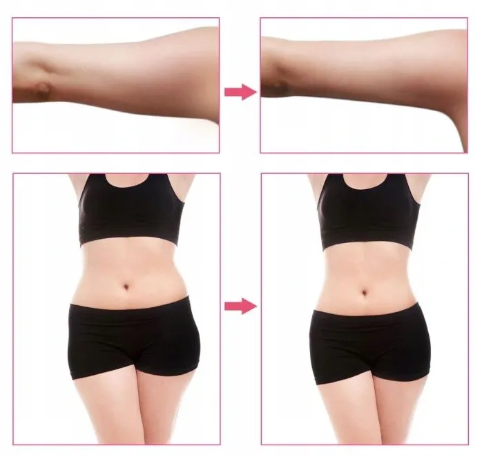 vigomed-mini-rf-liposukcja-lifting-stan-nowy