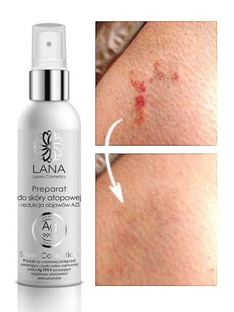 Preparat ze Srebrem na Atopowe Zapalenie Skóry AZS Natura Medica 100 ml