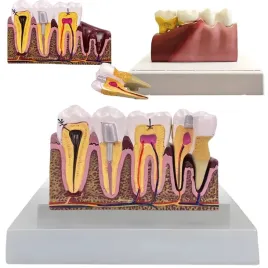 model-anatomiczny-zeba-stomatologiczny-edukacyjny-przekroj-wyjmowany-zab