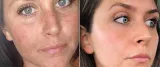 4x-eleverskin-glow-mlody-wyglad