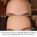 beyond-derma-roller-dermapen-walek-regenerujacy-stan-nowy