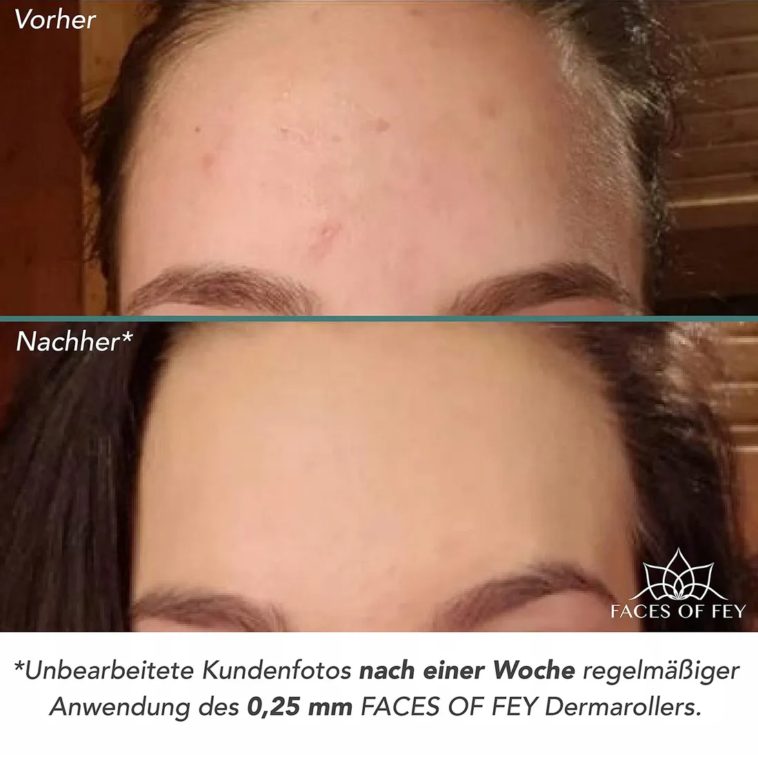 beyond-derma-roller-dermapen-walek-regenerujacy
