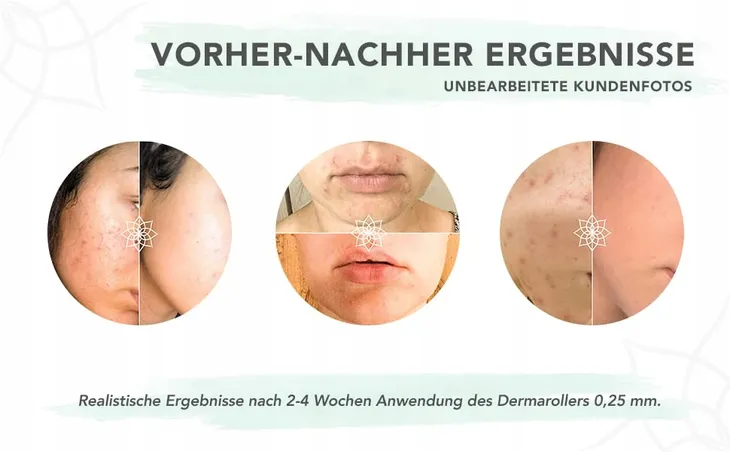beyond-derma-roller-dermapen-walek-regenerujacy-marka-inna-marka-zasilanie-akumulatorowe-bateryjne-sieciowe-sieciowo-akumulatorowe-brak