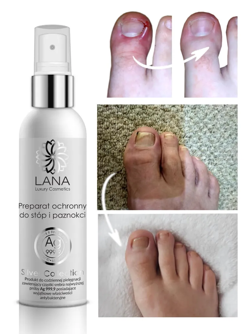 spray-ochrony-do-stop-i-paznokci-grzybica-pocenie-nieprzyjemny-zapach-stop-stan-nowy