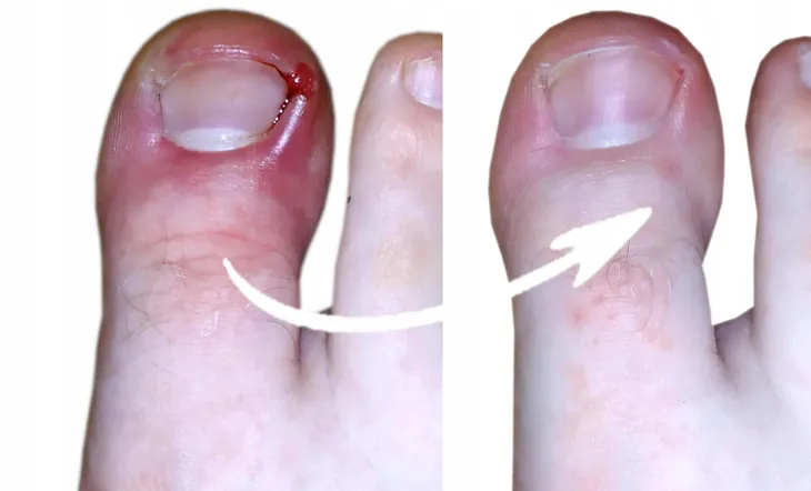 ag-preparat-do-stop-przeciwgrzybiczy-spray-3x100ml-produkt-nie-zawiera-alkoholu-aluminium-amoniaku-olejow-mineralnych-parabenow-parafiny-peg-silikonow-skladnikow-pochodzenia-zwierzecego-sles-sls-substancji-zapachowych