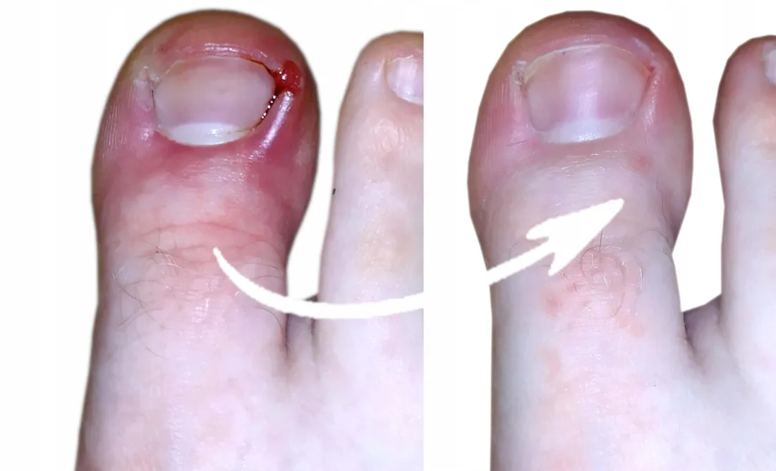 ag-preparat-do-stop-przeciwgrzybiczy-spray-3x100ml-stan-nowy