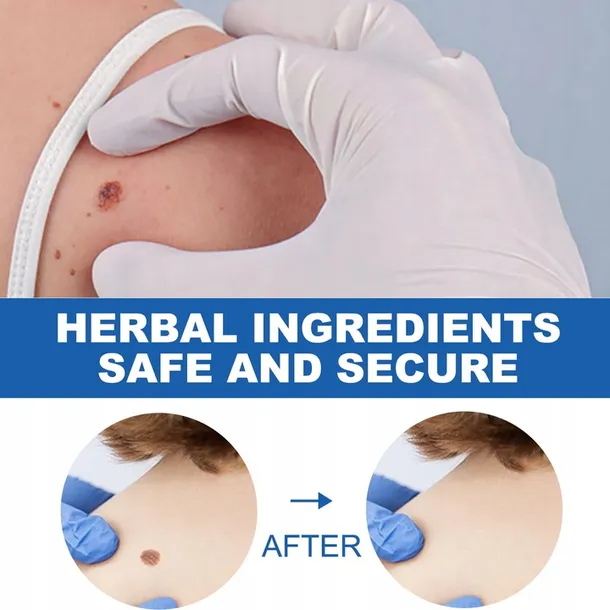 oryginalne-pioro-do-usuwania-brodawek-opakowanie-butelka