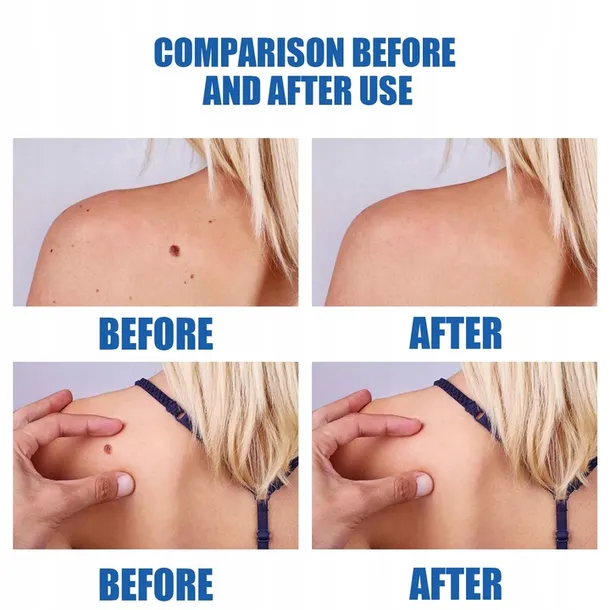 oryginalne-pioro-do-usuwania-brodawek-stan-nowy