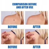 oryginalne-pioro-do-usuwania-brodawek-stan-nowy