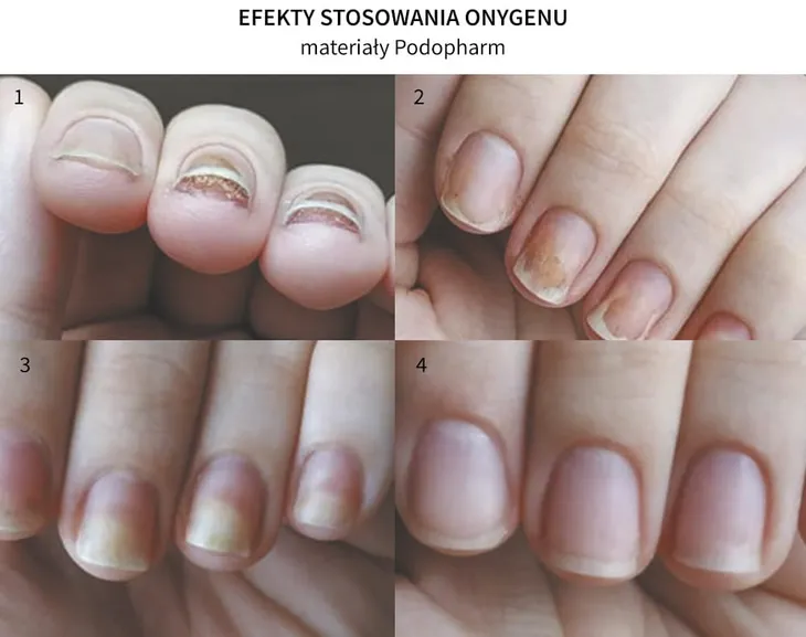 podopharm-onygen-krem-na-uszkodzone-paznokcie-20-ml-marka-podopharm