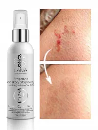 preparat-ze-srebrem-na-atopowe-zapalenie-skory-azs-natura-medica-100-ml