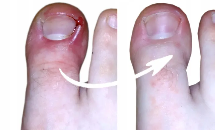 spray-z-jonami-srebra-na-grzybice-paznokci-3x100ml