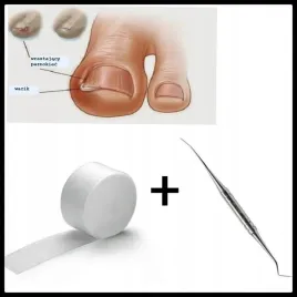 wrastajace-paznokcie-sonda-tamponada-opatrunek