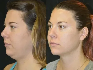 masazer-twarzy-lifting-podbrodka-terapia-5-trybow-stan-nowy-marka-inna-marka-moc-0-w