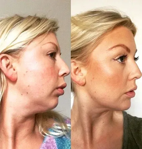 masazer-twarzy-lifting-podbrodka-terapia-5-trybow-marka-inna-marka-stan-nowy-moc-0-w