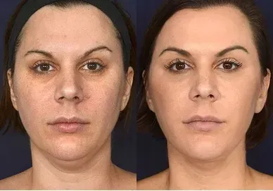 masazer-twarzy-lifting-podbrodka-terapia-5-trybow-marka-inna-marka-moc-0-w-stan-nowy