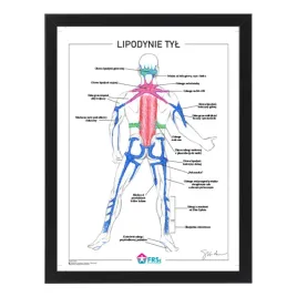 plakat-anatomiczny-lipodynie-tyl-w-ramce-33x43-cm-skladowski