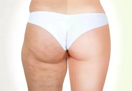 oligo-dx-na-cellulit-celulitnr1-w-rankingach-g-waga-300-g