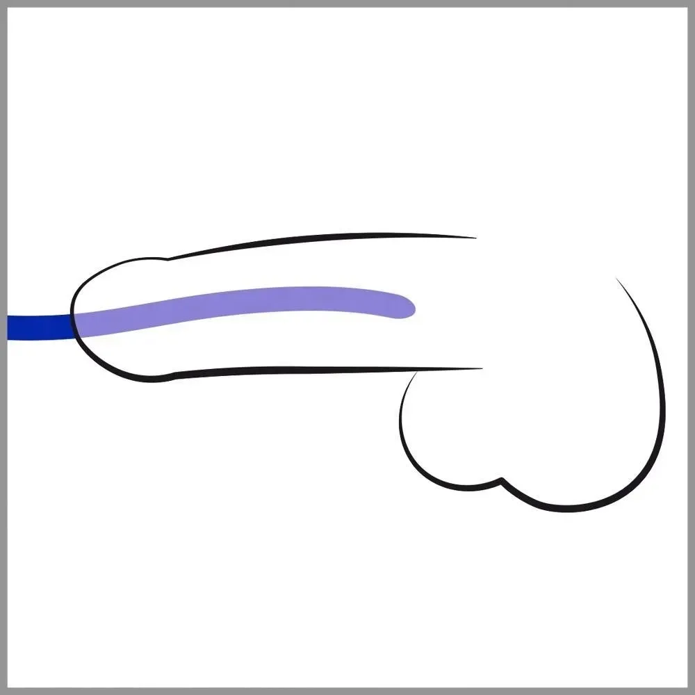 silicone-dilator-set