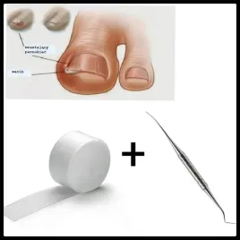 wrastajace-paznokcie-sonda-tamponada-opatrunek