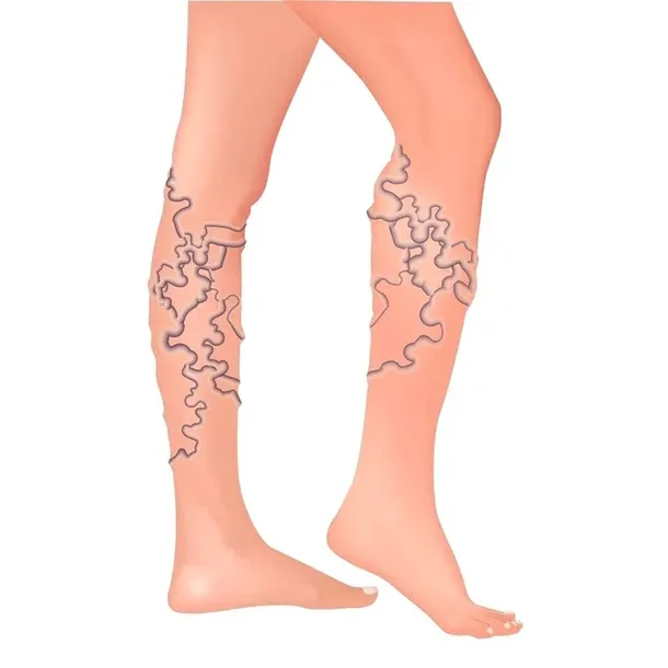 na-zylaki-i-pajaczki-uczucie-ciezkich-nog-olej-rycynowy-oryginalny-z-marka-laroxy