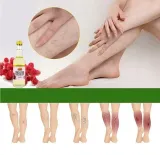 na-zylaki-i-pajaczki-uczucie-ciezkich-nog-olej-rycynowy-oryginalny-z-opakowanie-butelka