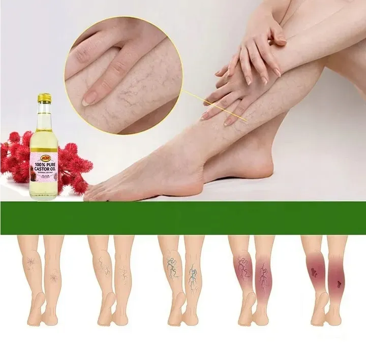 na-zylaki-i-pajaczki-uczucie-ciezkich-nog-olej-rycynowy-oryginalny-z