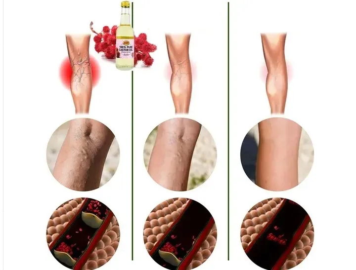 na-zylaki-i-pajaczki-uczucie-ciezkich-nog-olej-rycynowy-oryginalny-z