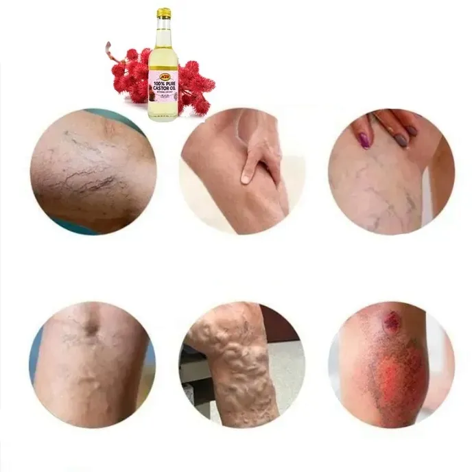 na-zylaki-i-pajaczki-uczucie-ciezkich-nog-olej-rycynowy-oryginalny-z