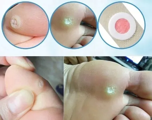 plastry-usuwajace-kurzajki-na-odciski-odciskow-stop-plastry-42-szt-stan-nowy