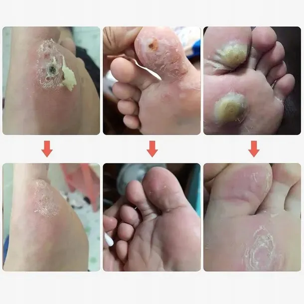 plastry-usuwajace-kurzajki-na-odciski-odciskow-stop-plastry-42-szt-typ-wyrobu-medycznego-wyposazenie-wyrobu-medycznego-lub-produkt-niemajacy-przewidzianego-zastosowania-medycznego