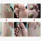 plastry-usuwajace-kurzajki-na-odciski-odciskow-stop-plastry-42-szt-typ-wyrobu-medycznego-wyposazenie-wyrobu-medycznego-lub-produkt-niemajacy-przewidzianego-zastosowania-medycznego