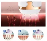 depilator-laserowy-sposob-depilacji-impuls-swiatla