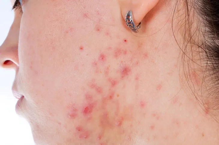 mydlo-na-luszczyce-egzeme-grzybice-chorych-na-azs-tradzik-dziegciowe-plynie-przeznaczenie-uniwersalne