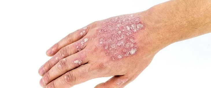 mydlo-na-luszczyce-egzeme-grzybice-chorych-na-azs-tradzik-dziegciowe-plynie-opakowanie-butelka-z-pompka