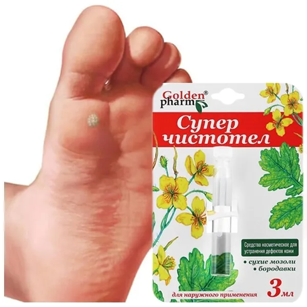 odcisk-na-stopie-z-korzeniem-jak-usunac-modzele-nagniotki-kurzajka-glistni