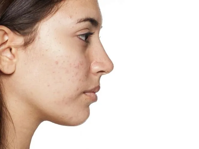 mydlo-z-kwasem-salicylowym-siarkowe-na-lupiez-pstry-mocne-linia-mydlo-na-tradzik-pryszcze-ropne-wagry