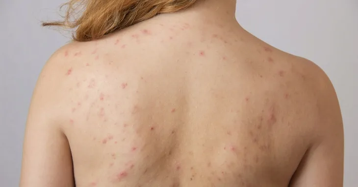 mydlo-z-kwasem-salicylowym-siarkowe-na-lupiez-pstry-mocne-marka-golden-pharm