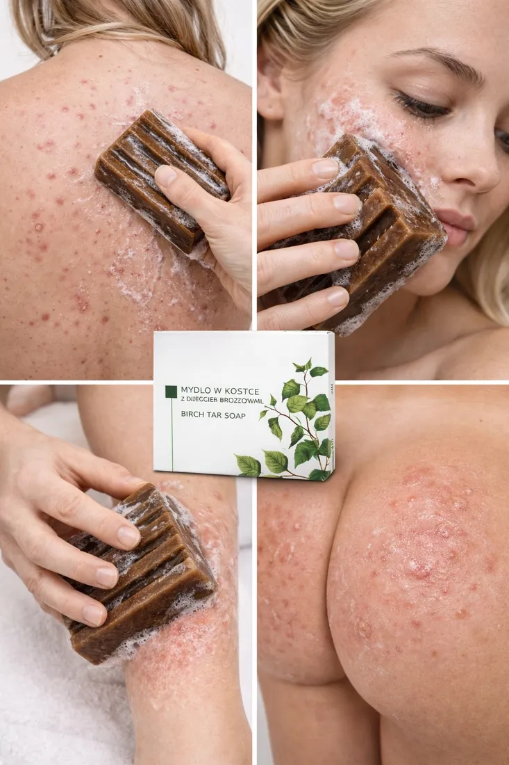 mydlo-dziegciowe-na-tradzik-pryszcze-nuzenca-azs-egzeme-luszczyce-100g