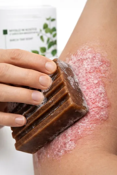 mydlo-dziegciowe-na-tradzik-pryszcze-nuzenca-azs-egzeme-luszczyce-100g-wielkosc-produkt-pelnowymiarowy