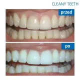 zestaw-cleanyteeth-rose-gold-zasilanie-akumulatorowe