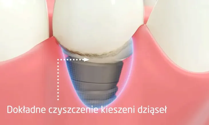 zestaw-cleanyteeth-rose-gold-typ-szczoteczki-ultradzwiekowa