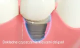 zestaw-cleanyteeth-rose-gold-typ-szczoteczki-ultradzwiekowa