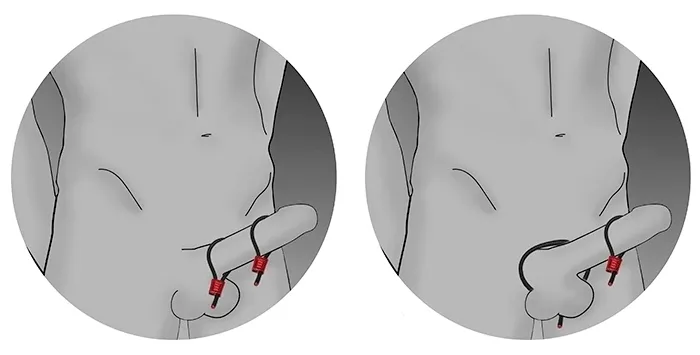 electrastim-prestige-electraloops-srebrny