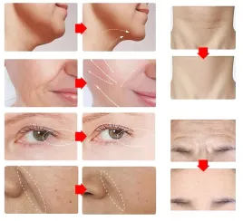 mezoterapia-beziglowa-masazer-ems-twarzy-lifting-odmladzanie-3x-led-v3-0